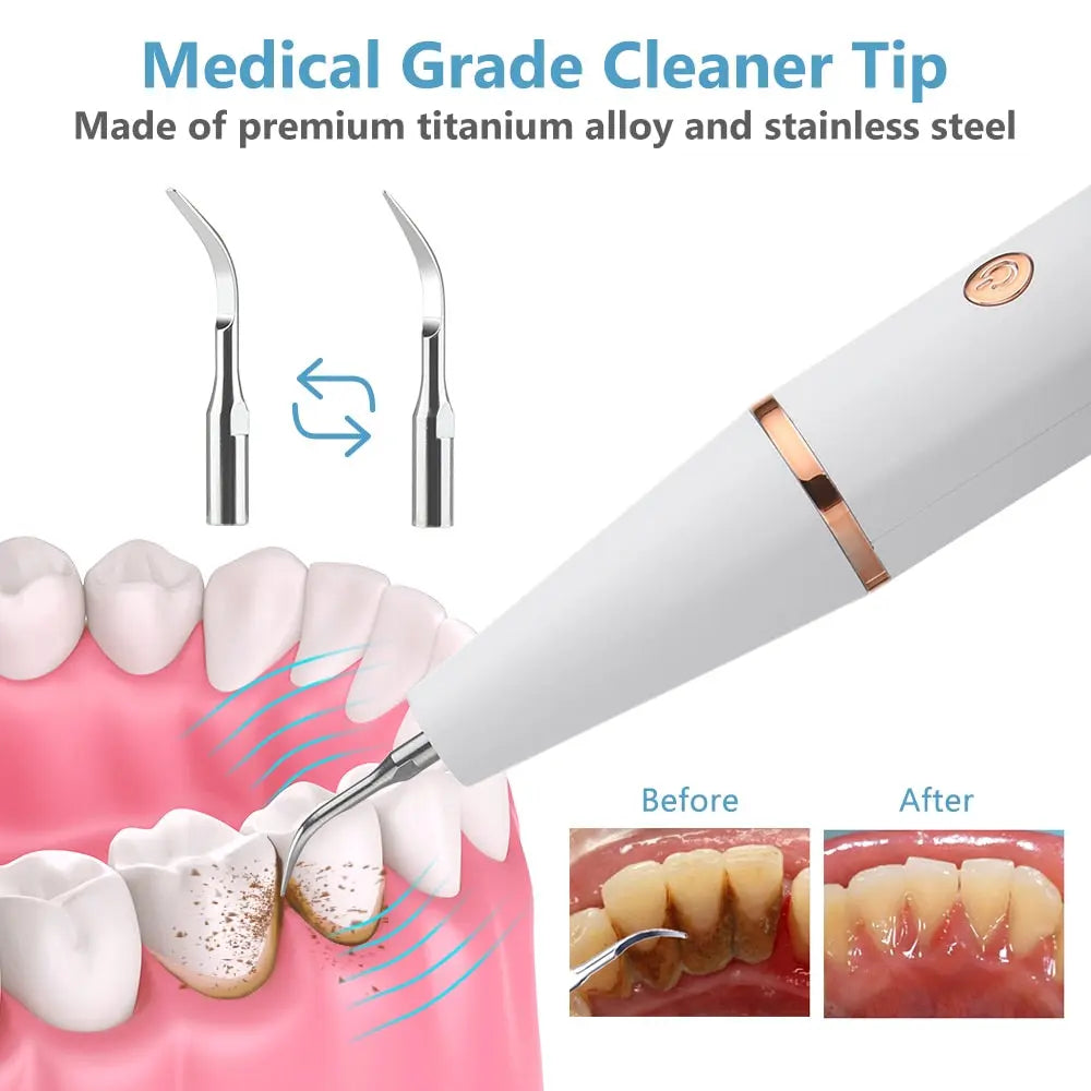 Advanced Ultrasonic Dental Scaler: Electric Tartar Remover for Calculus & Stains with LED